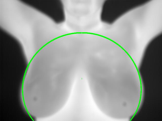 ROI Extraction for Thermographic Breast Images project preview